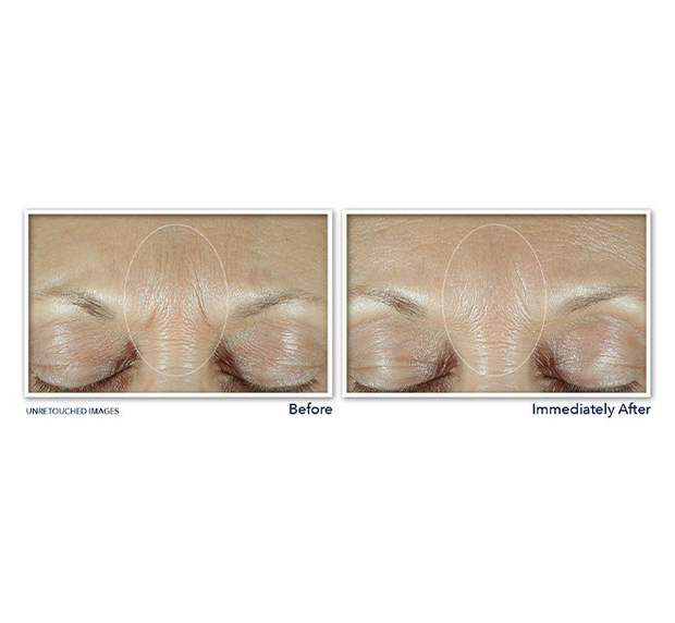 ROC Derm Correxion Fill + Treat Serum